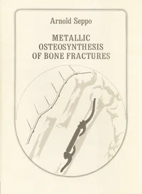 Metallic osteosynthesis of bone fractures based on the topography of bone resistance